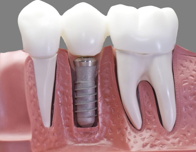 Capped Dental Implant Model